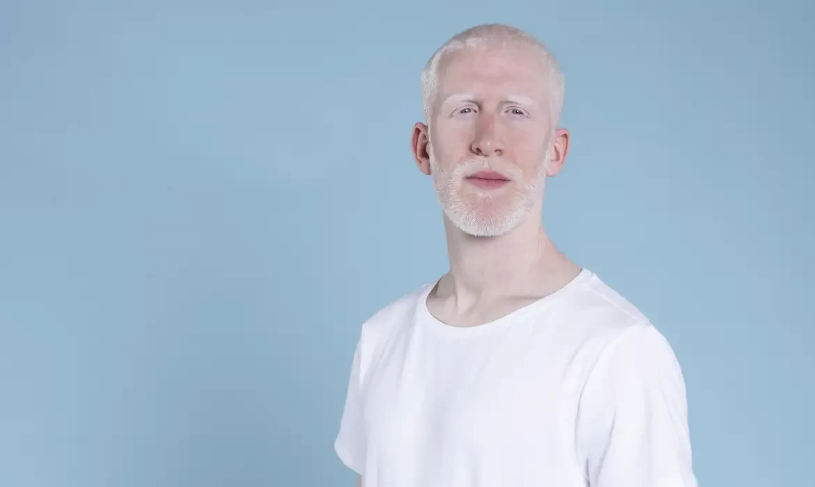 Sancionada lei que cria política de proteção a pessoas com albinismo