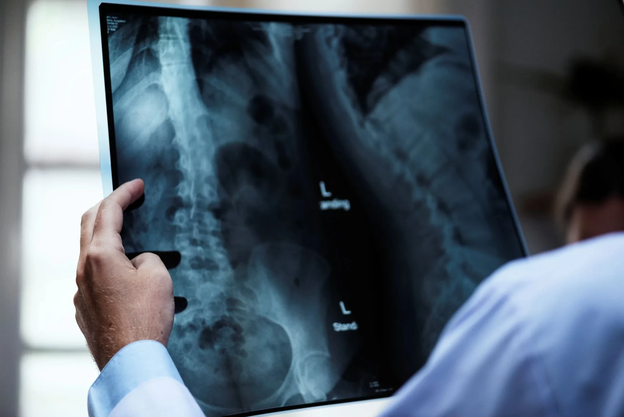 Osteoporose atinge homens e mulheres de maneira diferente; veja cuidados