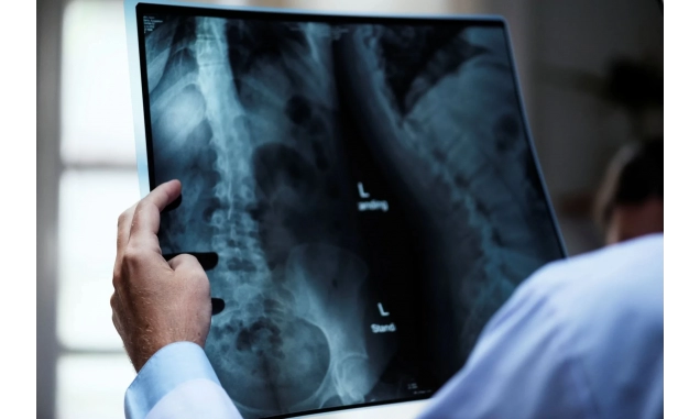 Osteoporose atinge homens e mulheres de maneira diferente; veja cuidados