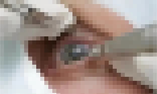 Cirurgia que altera cor do olho tem uso restrito para pessoas cegas